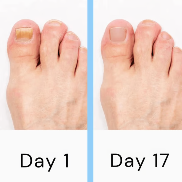 Raxiva-nail laser fungus treatment device