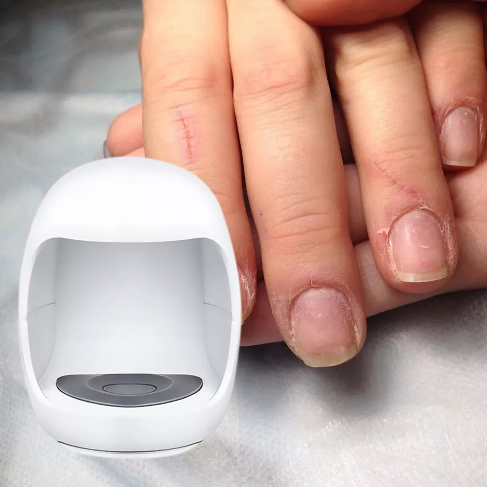 Raxiva-fungal laser toe treatment clip device